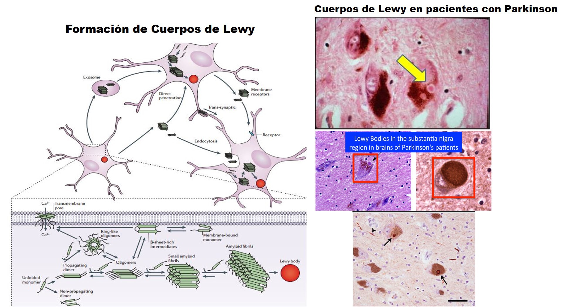 Cuerpo de Lewy
